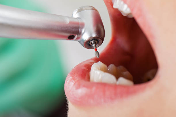 Best Lost Filling or Crown Replacement in Escatawpa, MS